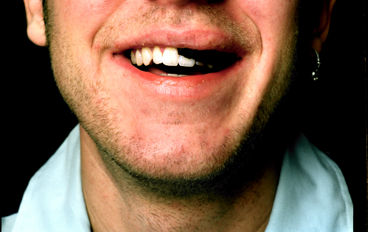 Snus under l&auml;ppen
